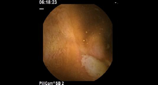 楕円形潰瘍および輪状潰瘍瘢痕