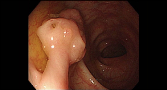 内視鏡検査画像