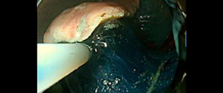 内視鏡的粘膜下層剥離術（ESD）