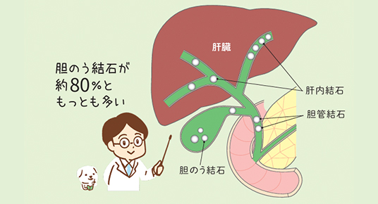 胆石とは？