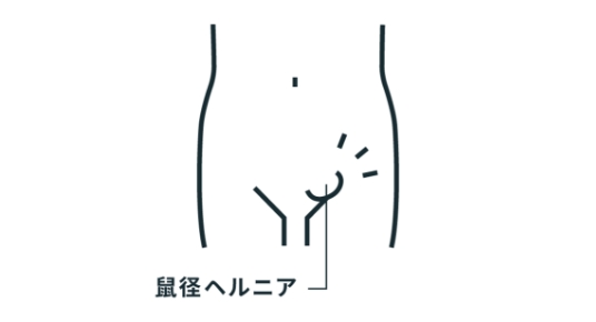 鼠径ヘルニア（脱腸）とは？