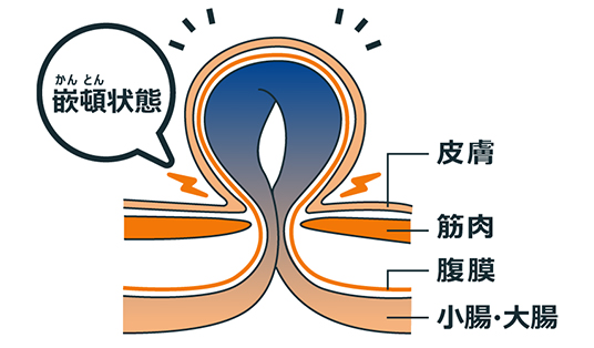 鼠径ヘルニア（脱腸）とは？