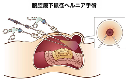 株式会社メディコン「鼠径ヘルニアノート」Webサイトより