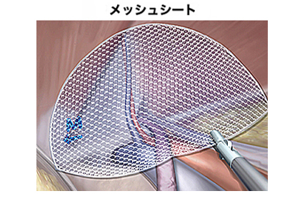 株式会社メディコン「鼠径ヘルニアノート」Webサイトより